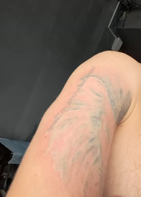 Удаление тату лазером